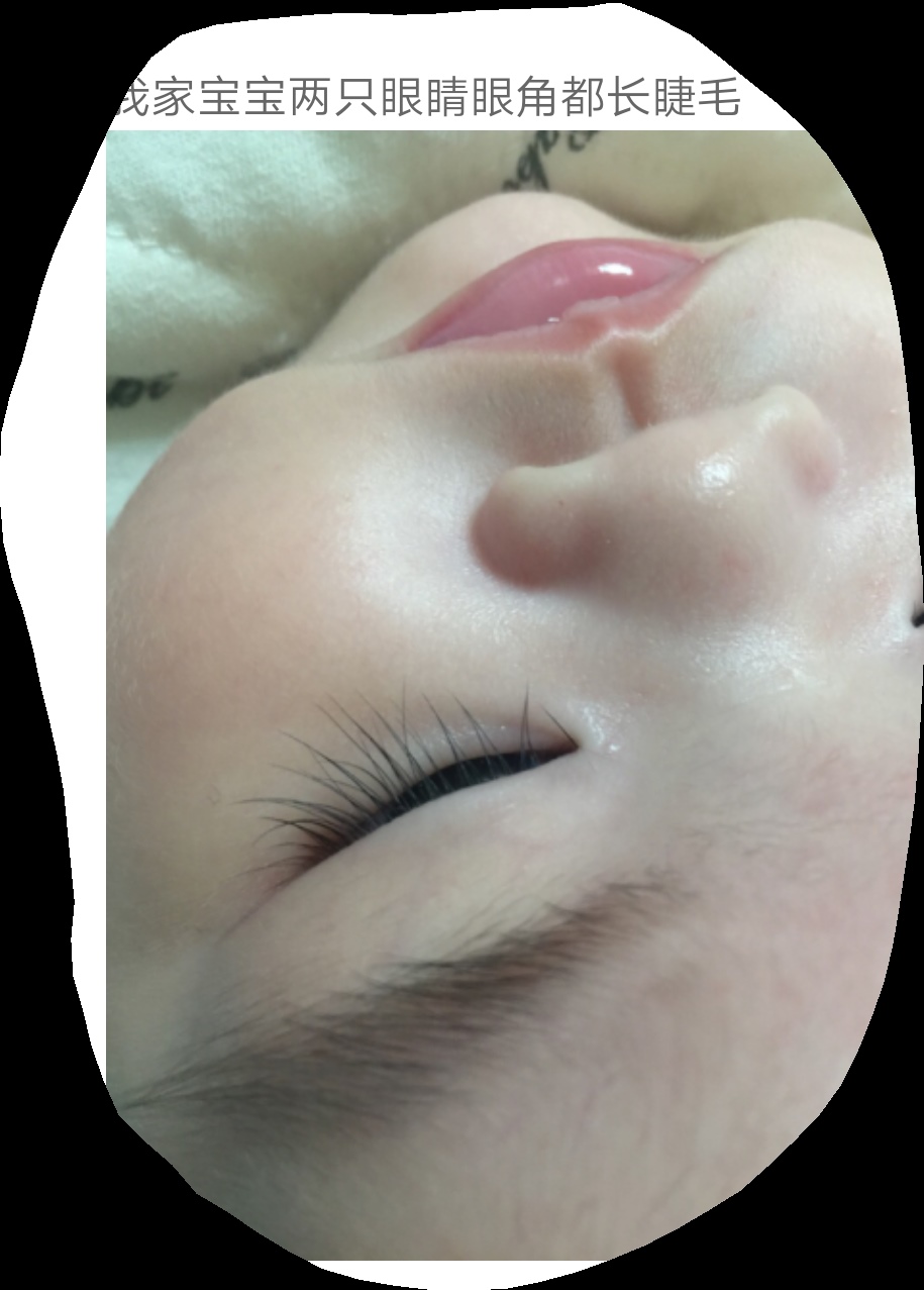 宝宝眼角长睫毛，要紧吗，你们宝宝有长过吗
