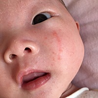 有经验的宝妈帮忙看一下这是湿疹吗？什么原因引起的？