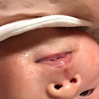 这个是湿疹还是？脖子下巴嘴巴附近最近出了很多，求方法