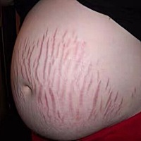 生完宝宝，肚子花了，现在老公在也没有像之前那样热情了，感觉变了许多