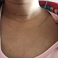 有没有生完娃颈纹加深的，之后会不会好点，其实之前也挺深的，但是无端端又多了几条，以后怎么穿没领口...