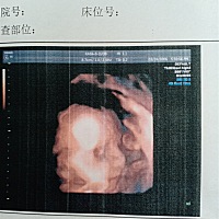 宝宝配合的特别好 不知道是男宝还是女宝