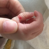 宝宝手上有这种血管瘤的痣……咋整呀……医生让观察，回头大一点再带她去儿童医院看一下，怕越大越不好治
