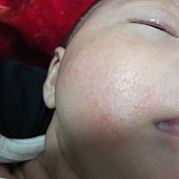 这是什么东西？宝宝的脸上两边都是密密麻麻的，有懂得宝妈吗？请教一下 好着急