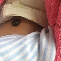 宝宝的肚脐还没有脱落，今天用酒精消毒完后感觉有一股味道，刚开始还以为是酒精味道后面感觉不对大晚上...