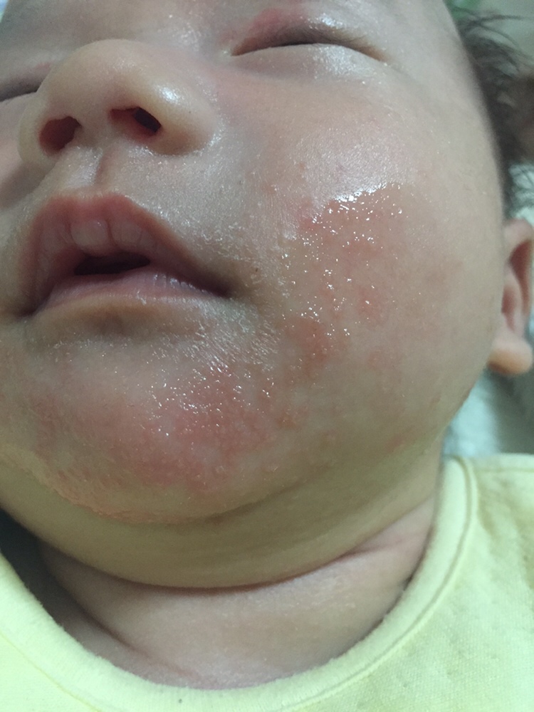 请问大家这是湿疹吗？摸上去很粗糙，好像藓一样的，涂了茶油，红霉素眼膏都没有用，求招啊