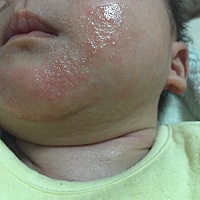 请问大家这是湿疹吗？摸上去很粗糙，好像藓一样的，涂了茶油，红霉素眼膏都没有用，求招啊