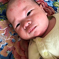 请问这是湿疹吗？之前涂过药膏，还是反复总出，怎么办？