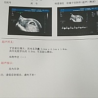 B超显示有胎心胎芽啦，可是上面写的好简单呀