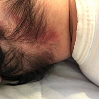 请问这是胎记吗？在后脑勺这里的红红的一块    ，有没有事情呀