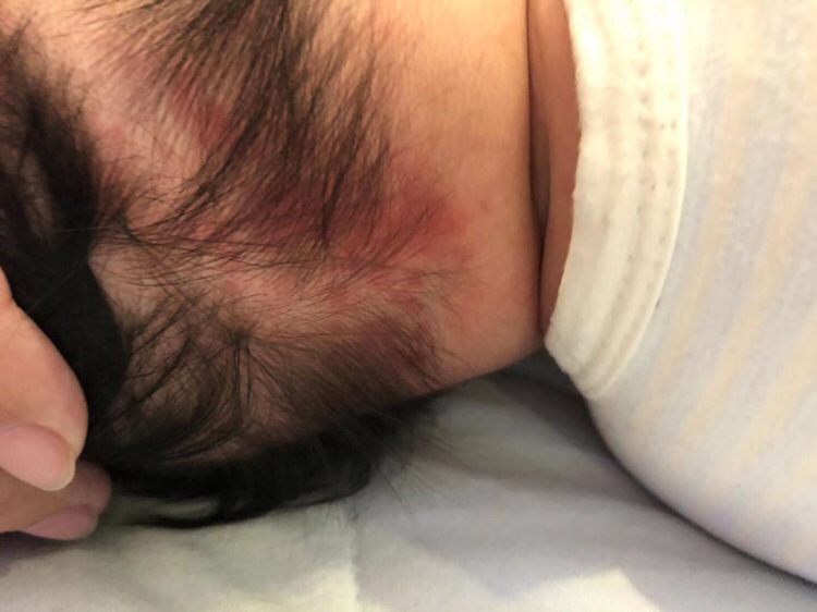 请问大家这是胎记吗？在后脑勺下面一点的位置