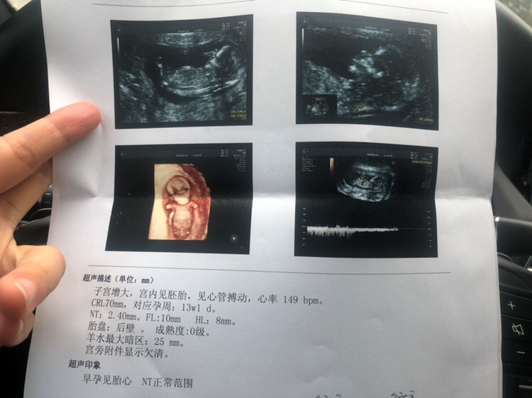 今天NT顺利通过✌️！
但我的NT值貌似比较高 
有类似的姐妹吗 ？