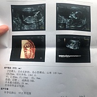 今天NT顺利通过✌️！ 但我的NT值貌似比较高  有类似的姐妹吗 ？