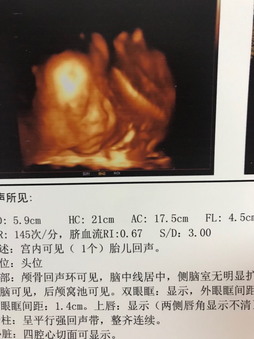 宝宝和四维照片基本无差别 嘿嘿😁