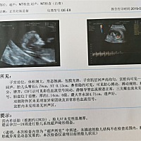 壹壹宝贝可真会折腾，终于做好了NT，要过四天再给医生看，应该是没事儿吧。 小家伙，12周零4天，从上午...