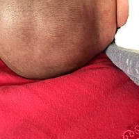 脖子上的红印子是什么？