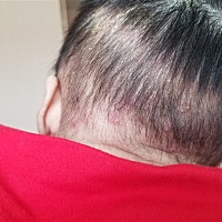 宝宝头上起了好多小脓包，医生说可能是毛囊炎，有类似的吗，宝贝一碰就疼，心疼死了，怎么缓解，求告知