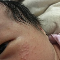 宝妈们，我家宝宝20天，脸上出了乐敦这种小疙瘩，这是什么，用不用管它