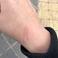 生完孩子两个多月身上皮肤就起这种红色的印子，不痛不痒，十几分钟后就消失了，每天都反反复复的长，红...