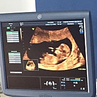 nt一次性过，有哪位宝妈可以看的出是男宝宝还是女宝宝