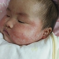 宝宝湿疹大家有什么好的方法吗
