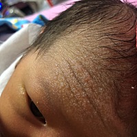 孩子额头一层白泡泡 怎么办啊 这是什么