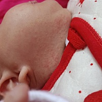 宝宝湿疹怎么办？有没有办法治疗一下