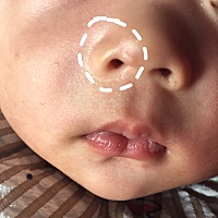 我家宝宝鼻子口边上（如图），看过医生说是疤痕，开的药（疤痕宁）涂了，刚涂了一天观察看看，有没有宝...