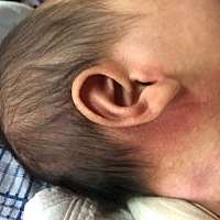 有妈知道我宝宝耳朵背后是长了啥吗 开始额头和脸颊也有 已经好了 但是耳朵这里不知道怎么成了这样 还有...