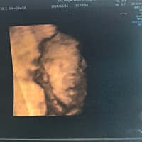 相信很多宝妈做四维时除了希望孩子身体健康之外，还想看看孩子到底长什么样。从来没有重男轻女思想的我...