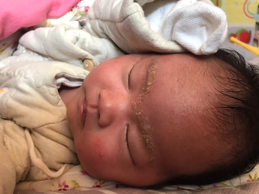 以前有黄疸，大家看看现在还黄吗