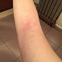 有孕妈 孕期得湿疹的吗 有啥方法吗 我这湿疹巨恐怖 已经挺了一个月 去 我们这的皮肤病医院看 也没啥效果...