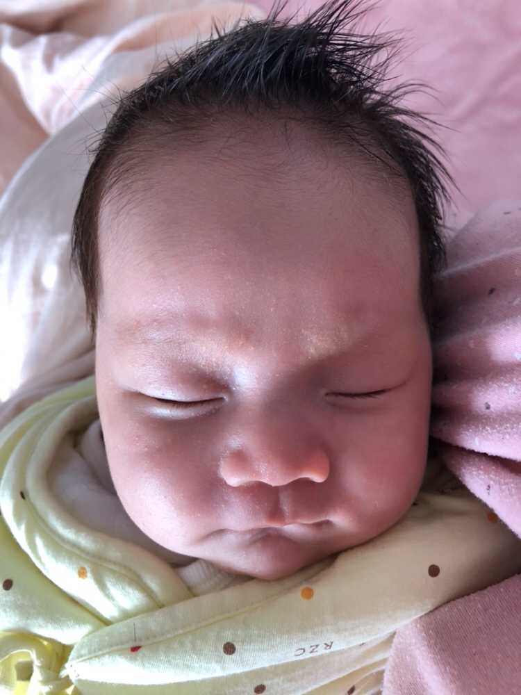 求助各位宝妈，眉毛上的白色结痂是什么，需要处理吗