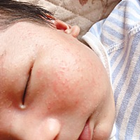 有宝妈知道宝宝脸上起的什么吗？用什么能好 求告知