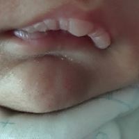 小孩生下来没多久嘴巴上好像就有一层皮 然后到现在快45天了还是这样 一层一层脱皮 是不是奶泡？还是缺维...