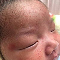 宝宝脸上长的是什么？是过敏还是湿疹？