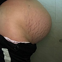 定了3月4日，正月28刨，老大也是刨的，好紧张，据说二刨很疼，祈祷一切顺利！