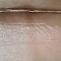 今天刀口第十天了，刚撕开纱布！ “怀胎十月，一朝分娩”，其中的艰辛和不易只有妈妈自己知道！所以，第...