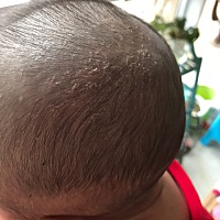 有宝妈知道宝贝头上长的是什么吗？每天晚上不停的抓头，头上都是血印子