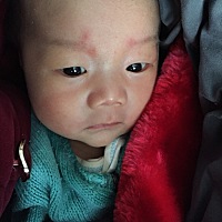 有没宝宝有脐疝的？ 怎么弄好的？