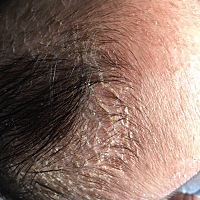 宝宝俩个月，头顶脱皮如图，就头顶部有，后脑没有。请问有没有知道的宝妈，这是怎么回事，可以用什么药...