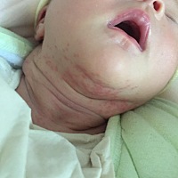 急急急，宝妈进来帮看下！！月子第17天，各位宝妈帮忙看下，宝宝这是湿疹还是痱子啊，擦了婴宝不见好啊...