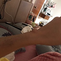 刚生完宝宝没多久，得了妈妈手，有宝妈有什么治疗的方法吗？现在喂母乳也不好去动手术，这一颗腱鞘囊肿...