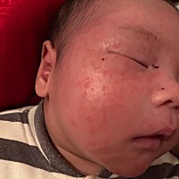 宝宝脸长满了湿疹，眉毛上有很厚的黄痂。看了都难受，朋友推荐买了这个，涂了几天效果确实不错。看网上...