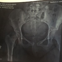 有宝妈这样的吗 产后耻骨联合分离 床都下不了 走路更别提了 目前宝宝九天了 恢复到能下床自己慢走了（跟...