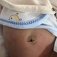 各位宝妈帮忙看下。图1这个肚皮有点红是什么原因。图2这个皮肤皱折脱皮了要怎么办？？谢谢大家！