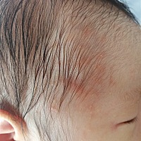 有哪位宝妈知道，整张脸都是。还在脖子跟屁屁上也有，这是怎么回事？应该注意什么？