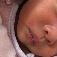 宝宝第九天 嘴角这里一块红 摸起来上面有小颗粒！求有经验的宝妈指点 谢谢🙏