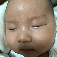 亲亲们，我家宝眉毛那里长了一些小疙瘩，黄色的，想问这个是不是湿疹啊？擦什么可以去掉？