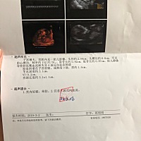 NT检查，胎儿心脏好像有点问题，医生说A波返流，又给做了DNA无创……还得等将近十天的结果，好揪心……